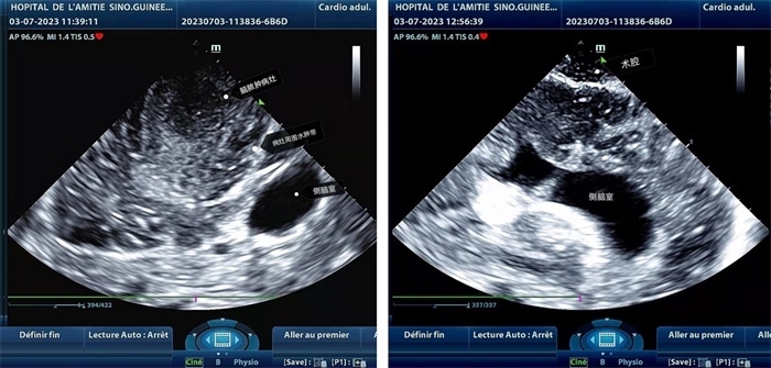 左圖顯示術(shù)中超聲見囊實(shí)性病變，大小約為4x4x3cm，病灶周圍腦組織水腫明顯；右圖為病灶切除后，術(shù)中超聲示術(shù)腔無病變殘留