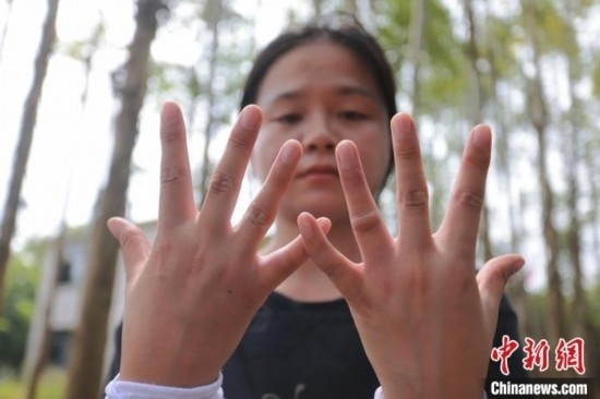 吳素英展示被蜜蜂蜇過的雙手。湯曉逵 攝