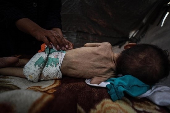這是5月28日在加沙城西部一處臨時(shí)安置點(diǎn)拍攝的一名營養(yǎng)不良的嬰兒。新華社發(fā)（馬哈茂德·扎基攝）